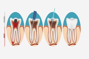 Root-Canals-Treatment