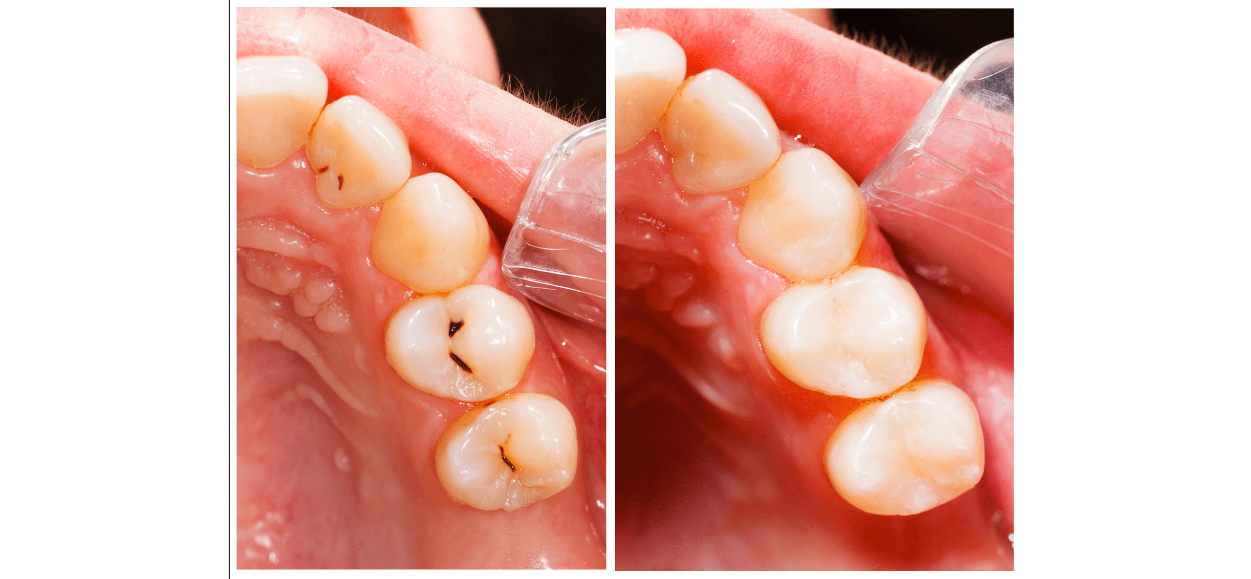 Dental Filling Image Example