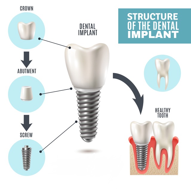 Dental-Implants-in-St-albert